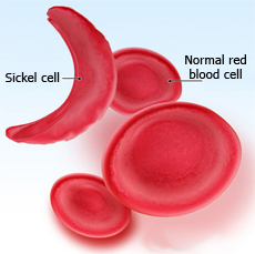 Sickle Cell Anemia: Preventing the Inevitable