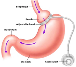 Gastric Banding: not a permanent solution for "obesity"