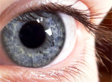 Exfoliation  Syndrome: a Cause of   Glaucoma