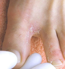 Athlete's foot 