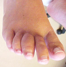 Hallux Rigidus: a Degenerative Toe Arthritis  