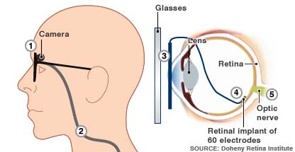Bionic Eye Implant