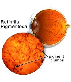 Retinitis Pigmentosa