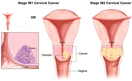 Cervical Cancer and Pregnancy