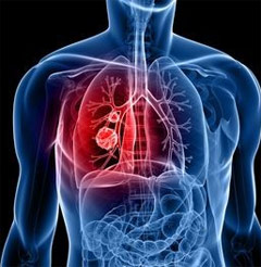   Small Cell Lung Cancer
