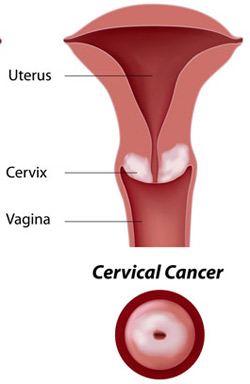 Cervical Cancer and Pregnancy