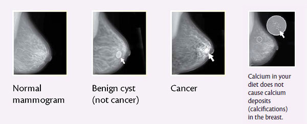 Mamography: the Breast Cancer Screening Tool