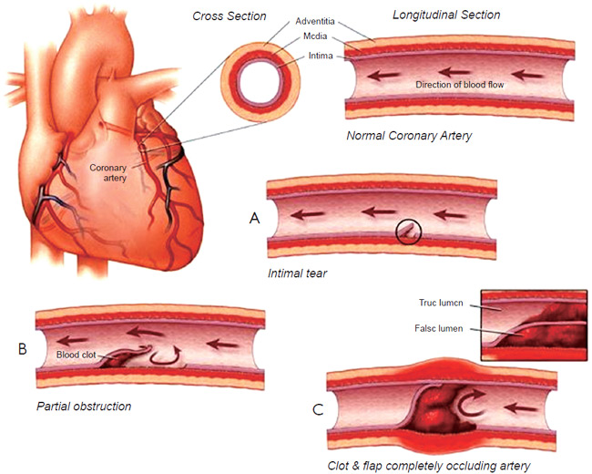 Spontaneous Coronary Artery Dissection (SCAD): A Rare Heart Condition in Women  
