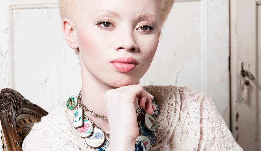 Living with Albinism