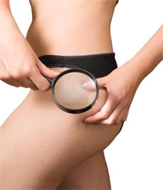 Common Myths About Cellulite