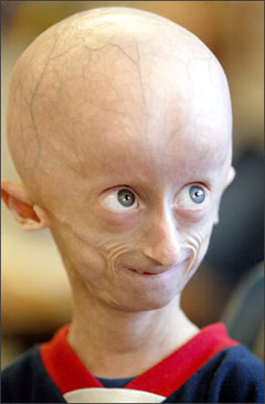   Progeria
