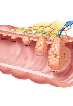 Physical activity Vs Cancer Risk