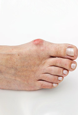 Hallux Rigidus: a Degenerative Toe Arthritis  