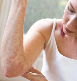Urticaria: A Distressing Disorder