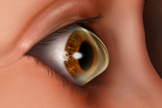 Keratoconus: causes, symptoms and treatment