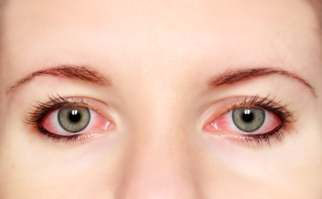 Keratoconus: causes, symptoms and treatment