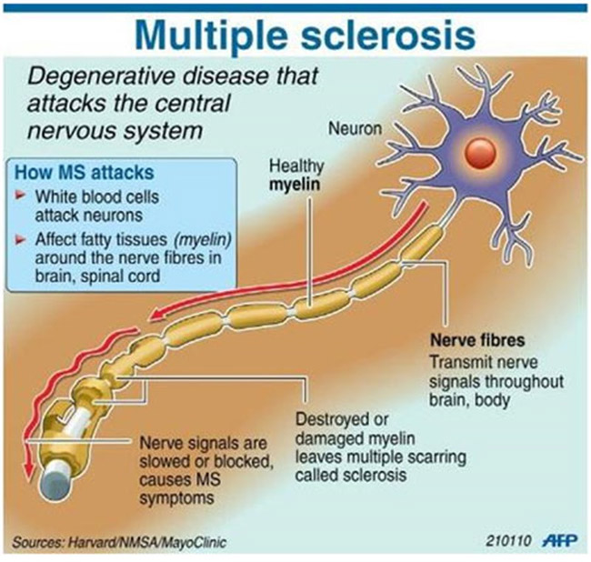 What is Multiple sclerosis?  