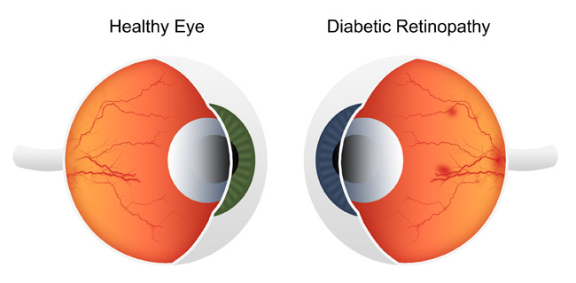 Diabetic Retinopathy