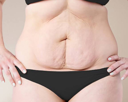 Loose Skin after Weight Loss