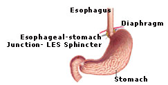 Stomach-stapling for successful weight loss