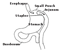 Stomach-stapling for successful weight loss
