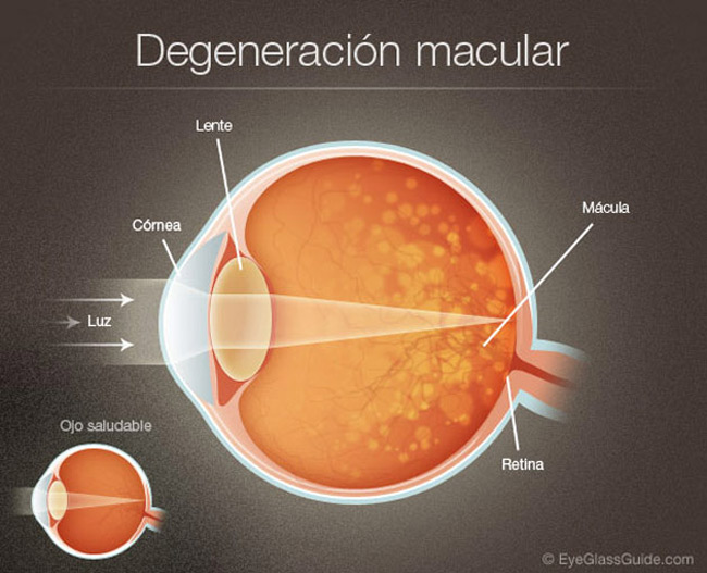 Macular Degeneration - Women Fitness