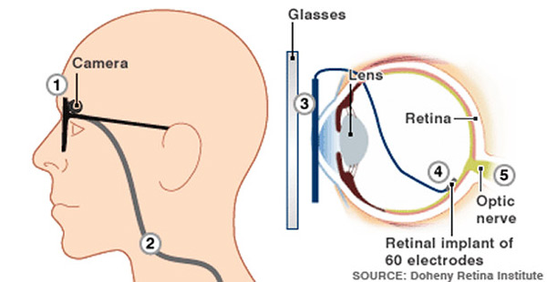 The Argus II Retinal Prosthesis System: Sight for the Blind