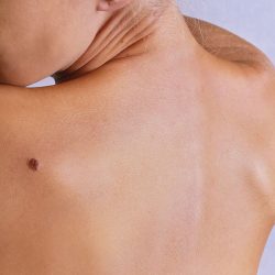 skin cancer risk