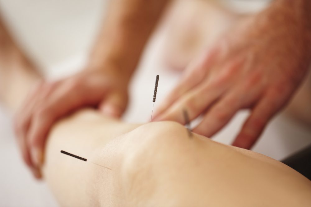Real acupuncture