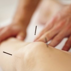 Real acupuncture