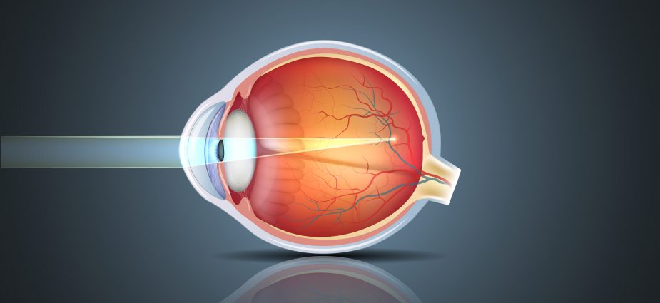 Laser Surgery for Myopia