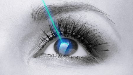 Laser Surgery for Myopia