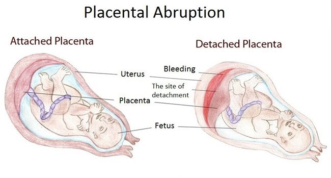 placental detachment symptoms of diabetes