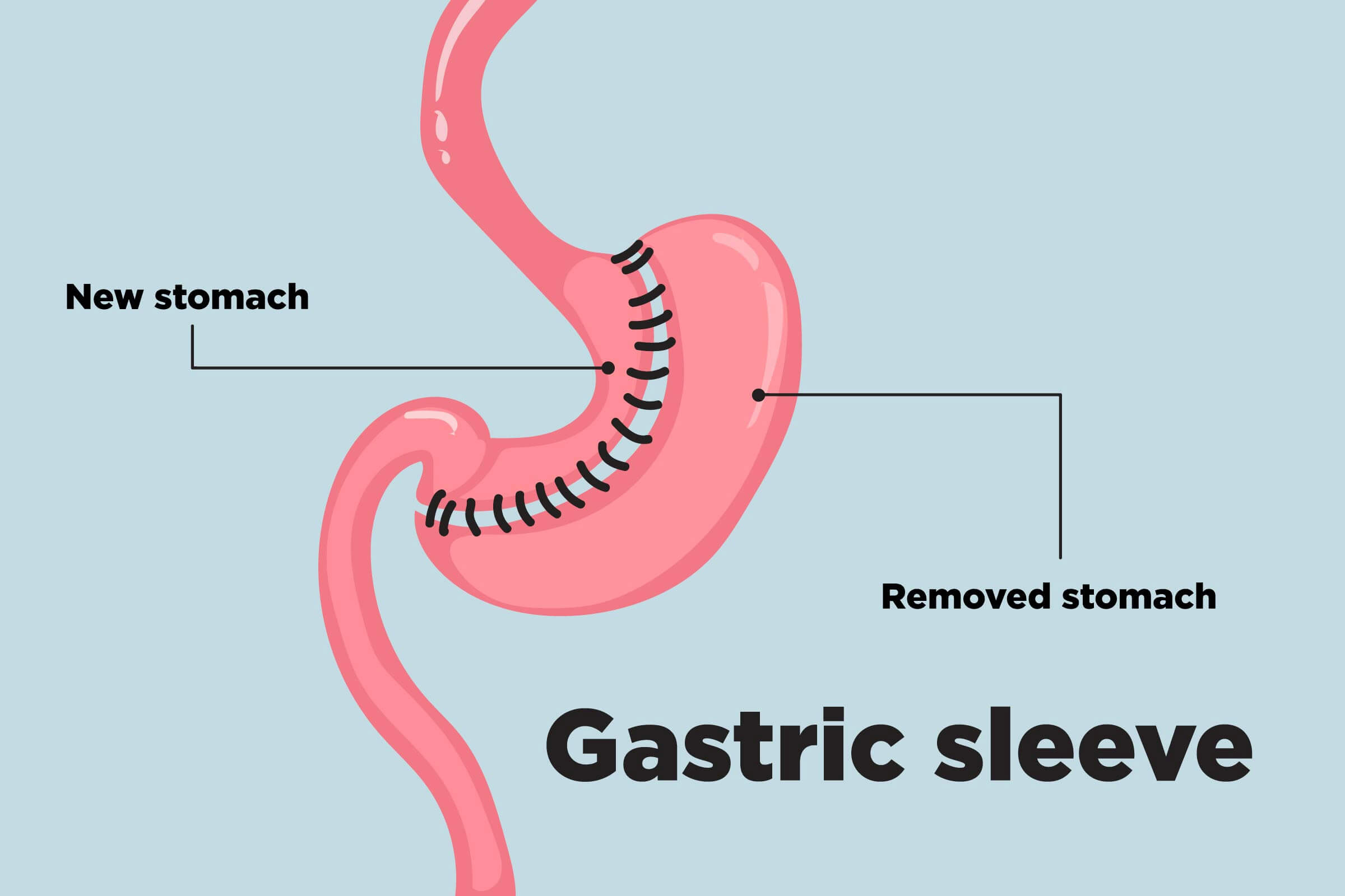 Am I a Candidate for Endoscopic sleeve gastroplasty?