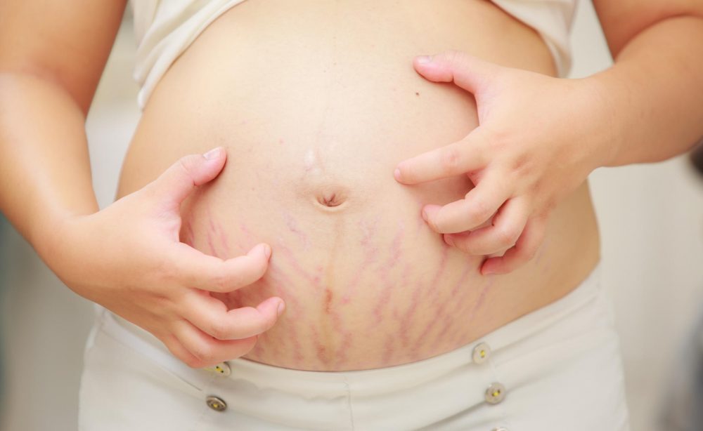 Psoriasis During Pregnancy