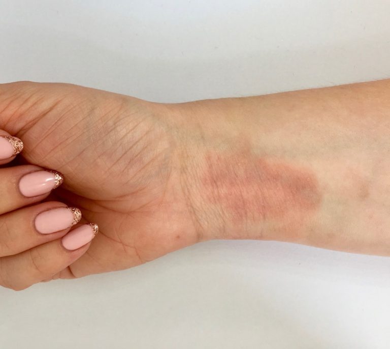 Biomedical Researchers get Closer to Why Eczema Happens Women Fitness