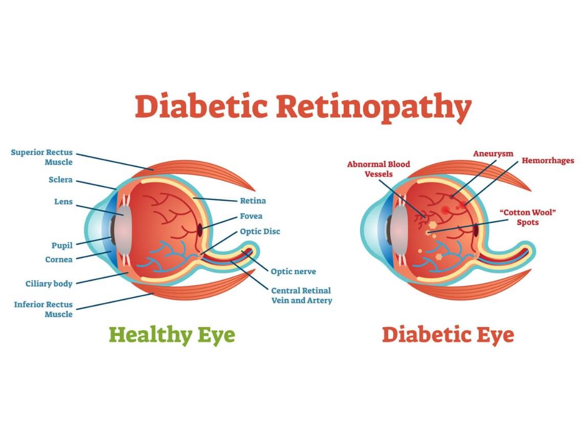 research on diabetic eye disease