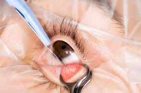 Chalazion or Eyelid Cyst