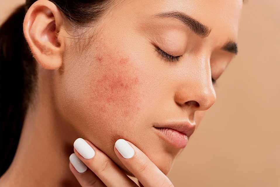 Poor Diet: A Contributing Factor in Acne