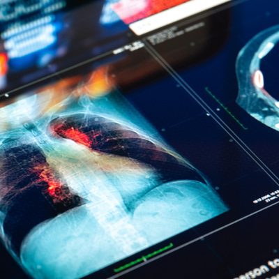 AI For Lung Tumors