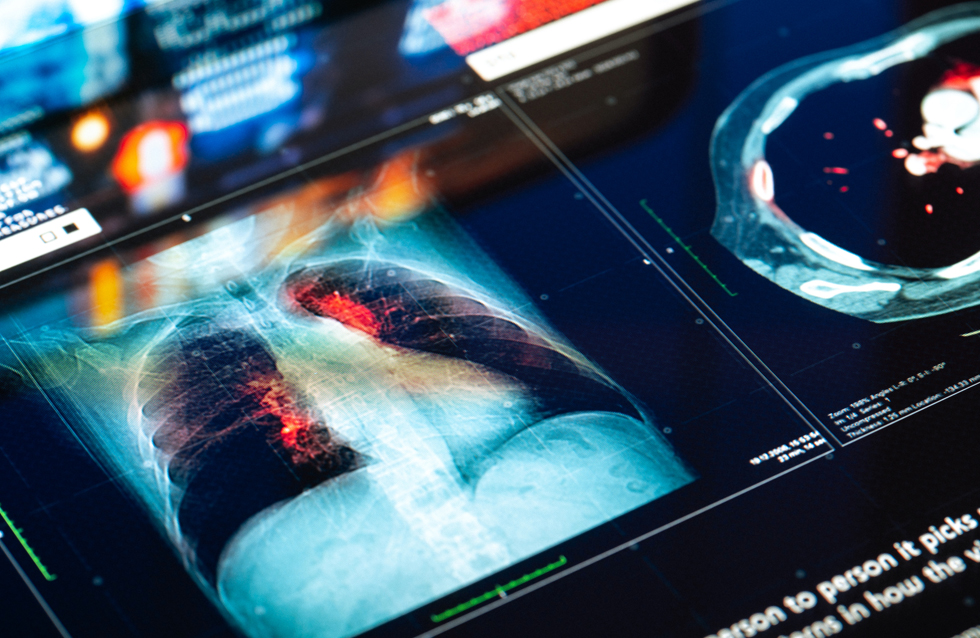 AI For Lung Tumors