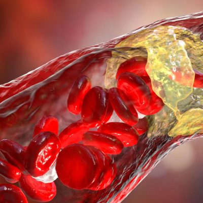 Everyday microplastics could be fueling heart disease