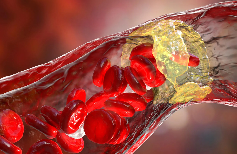 Everyday microplastics could be fueling heart disease